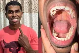 Tưởng mọc răng “bất thường”, chàng trai đi khám và phát hiện mình nắm kỷ lục hiếm có