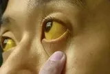 Nếu mắt có 6 thứ, đi khám ung thư ngay còn kịp!