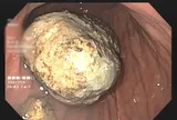 Tưởng đau bụng thông thường, người đàn ông 67 tuổi mang trong mình thứ "đáng sợ" khiến bác sĩ sốc ngang