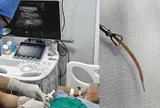 Đau bụng suốt 10 ngày, bất ngờ phát hiện tăm tre đâm thủng đại tràng