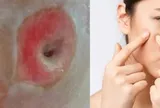 Người phụ nữ 40 tuổi chết lặng khi thấy mặt như "tổ ong" vì sai lầm ai cũng dễ mắc