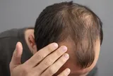 Thường xuyên ăn 5 món này, đừng trách vì sao tóc rụng lả tả