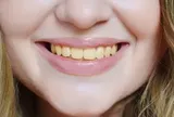 Chuyên gia chỉ ra 4 thực phẩm làm răng ố vàng, đánh mãi vẫn không trắng
