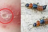 Những sai lầm phổ biến khi nhầm viêm da do kiến ba khoang với bệnh zona thần kinh