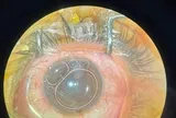 Người đàn ông bị dây cước đâm xuyên nhãn cầu trong khi đang làm việc