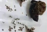 Bệnh sỏi thận: Vì sao trong cùng 1 quả thận lại có các viên sỏi khác nhau và chia sẻ của bác sĩ "không còn phải bổ đôi quả thận tìm sỏi"