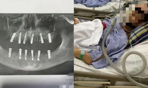 Người đàn ông tử vong sau khi cấy 6 implant và nhổ 12 răng cùng lúc