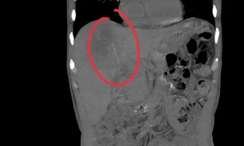 Người đàn ông đau bụng kéo dài, bác sĩ sốc khi phát hiện bí mật bên trong