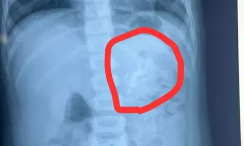 Bé trai liên tục nôn mửa, bác sĩ sốc nặng khi thấy thứ bên trong bụng