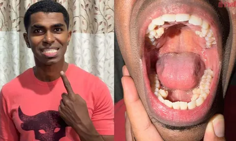Tưởng mọc răng “bất thường”, chàng trai đi khám và phát hiện mình nắm kỷ lục hiếm có