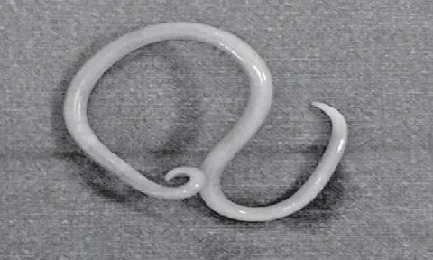 Thiếu niên 15 tuổi bị đau bụng thúc ngược lên, bác sĩ phát hiện "bí mật" đáng sợ bên trong