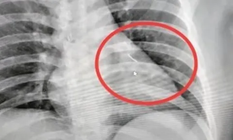 Người đàn ông bị đau ngực, bác sĩ sốc nặng khi phát hiện ra thứ bên trong
