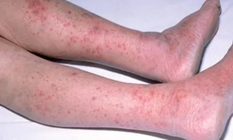 Căn bệnh là "sát thủ thầm lặng", người khỏe ngã gục chỉ trong 24 giờ: Bác sĩ chỉ cách phòng tránh