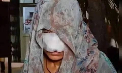 Cãi nhau, chồng cắn vào mũi và má khiến vợ phải khâu 10 mũi