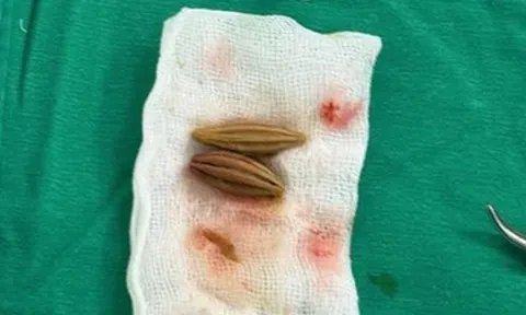 Nuốt nhầm hạt nhót, cụ bà nguy kịch