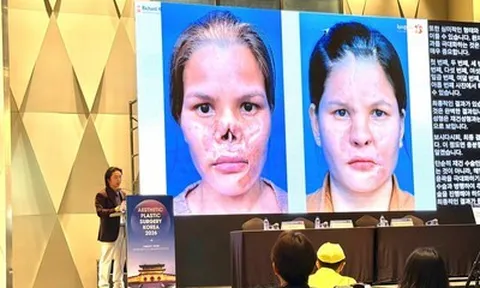 Giải pháp điều trị biến chứng sau nâng mũi gây chú ý tại Hội nghị thẩm mỹ quốc tế APS Korea 2026