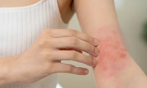 Luôn cảm thấy ngứa, cô gái 26 tuổi "sốc" khi biết mình mắc căn bệnh này