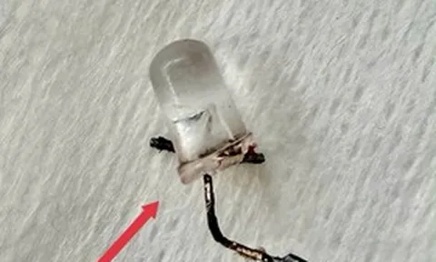 Bé 9 tháng tuổi ho nhiều ngày, bố mẹ "sốc" khi bác sĩ gắp ra đèn LED nằm trong phế quản