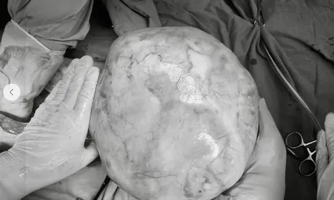 Phát hiện khối u "khủng" trong bụng bé gái 14 tuổi