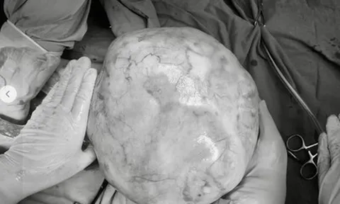 Bé gái 14 tuổi bụng to bất thường, bố mẹ sốc khi phát hiện bí mật "đáng sợ" bên trong