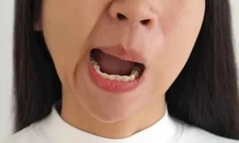 Cảnh báo bệnh liệt mặt "tấn công" giữa mùa hè: Đừng chủ quan với những "thủ phạm" ở ngay trong nhà