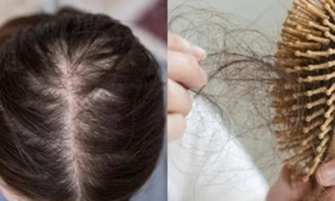 Đừng chỉ ăn trứng luộc để ngừa tóc rụng! "Nữ thần không tuổi" Thái Y Lâm luôn làm việc này trước 21h30 cho da đẹp tóc khỏe, bác sĩ cũng phải khen