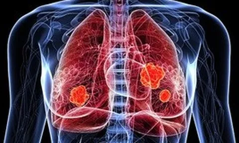 Con số đáng lo ngại về ung thư phổi tại Việt Nam