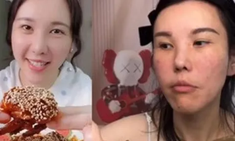 Mặt cô gái trẻ biến dạng sau 2 năm làm mukbang, bác sĩ cảnh báo 4 cái giá phải trả về sức khỏe ít ai biết đến