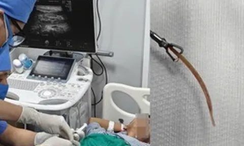 Đau bụng suốt 10 ngày, bất ngờ phát hiện tăm tre đâm thủng đại tràng