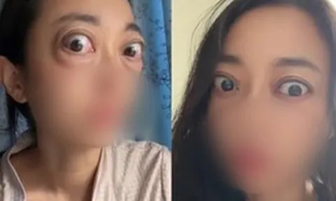Nhìn đôi mắt "ếch" của người phụ nữ, ai cũng thương, câu chuyện phía sau là bài học cảnh tỉnh nhiều người trẻ