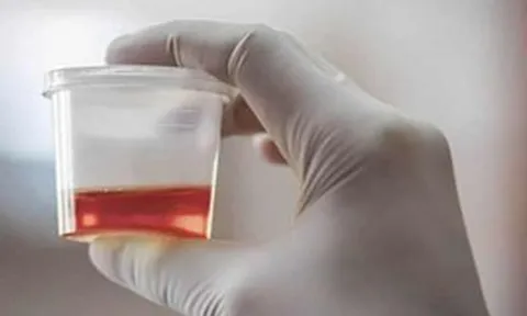 Bé trai 7 tuổi dập thận, tiểu ra máu sau khi chơi đùa với bạn trên lớp: Phó Giám đốc Bệnh viện Nhi Đồng 2 cảnh báo!