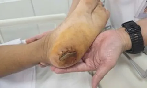 Bệnh viện Bạch Mai cảnh báo: Nhiều người đang phải nhập viện thở máy vì 1 căn bệnh do chủ quan vết thương nhỏ