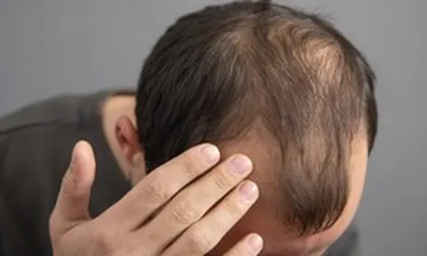 Thường xuyên ăn 5 món này, đừng trách vì sao tóc rụng lả tả