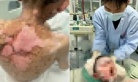 Bé trai 9 tuổi bong tróc da, loét khắp cơ thể, vảy dính kín mắt miệng, nguyên nhân từ 1 loại thuốc thông dụng trong mọi gia đình