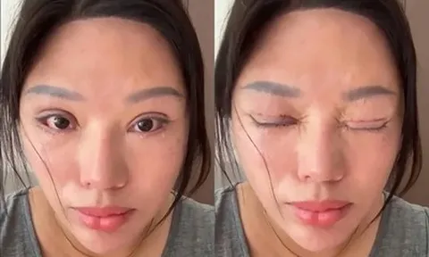 Người phụ nữ 6 năm không thể nhắm mắt khi ngủ, lý do phía sau khiến nhiều người bất ngờ