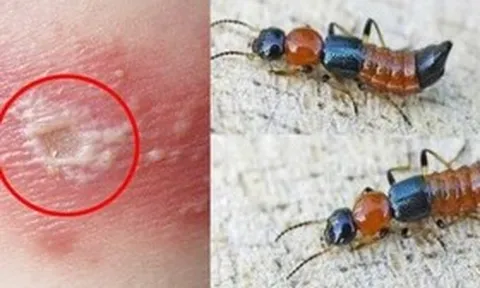 Những sai lầm phổ biến khi nhầm viêm da do kiến ba khoang với bệnh zona thần kinh