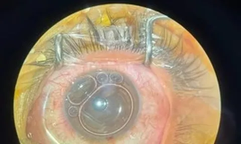 Người đàn ông bị dây cước đâm xuyên nhãn cầu trong khi đang làm việc