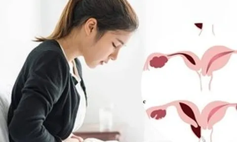 Đau bụng kinh suốt nhiều năm, nữ sinh 18 tuổi phát hiện dị tật hiếm: Bác sĩ bất ngờ khi thấy vòi tử cung đã hoại tử