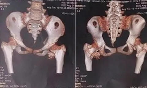 Bé gái 12 tuổi mắc "hội chứng người hóa đá" hiếm gặp, bố mẹ ngỡ ngàng khi bác sĩ nhắc tới cú ngã xe đạp 2 năm trước