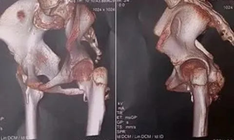 Phát hiện hội chứng "người hóa đá" thể hiếm ở một bé gái 12 tuổi