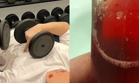 Chàng trai 26 tuổi tiểu ra máu, gan và thận đều tổn thương nặng vì 1 hành động ai cũng tưởng tốt khi giảm cân