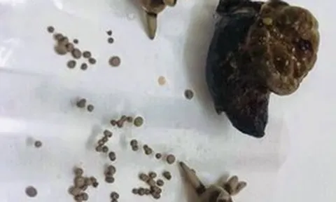Bệnh sỏi thận: Vì sao trong cùng 1 quả thận lại có các viên sỏi khác nhau và chia sẻ của bác sĩ "không còn phải bổ đôi quả thận tìm sỏi"