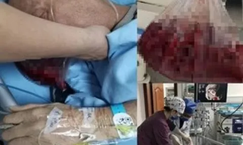 Người đàn ông nôn ra hơn 2 lít máu trong 5 phút, bác sĩ cảnh báo: 4 thói quen ăn uống "phá nát" dạ dày