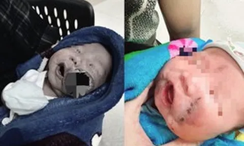 Nửa khuôn mặt bị u máu chiếm chỗ... và một cuộc chạy đua với từng giọt máu cứu sống em bé mới 1 tháng tuổi