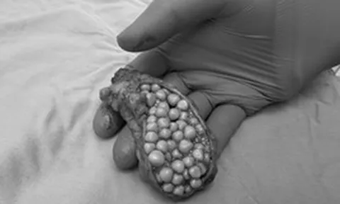 Người phụ nữ 38 tuổi đau bụng suốt 1 tháng, đi khám bác sĩ phát hiện “khối u bí ẩn” chứa 130 viên sỏi trông như “bọc trứng cá”