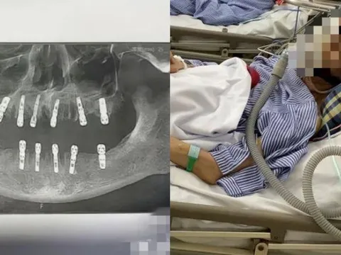 Người đàn ông tử vong sau khi cấy 6 implant và nhổ 12 răng cùng lúc
