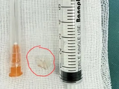 Bé trai 7 tuổi xẹp phổi trái, bác sĩ gắp ra thứ "đáng sợ" bên trong