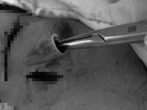 Bé trai đau vùng mắt dữ dội, bác sĩ sốc khi phát hiện dị vật "tàng hình"