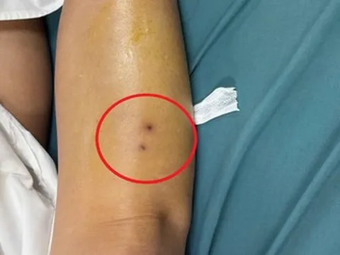 Suýt mất mạng vì rắn độc, người phụ nữ hồi phục thần kỳ sau 1 ngày điều trị