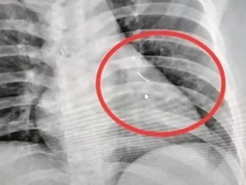 Người đàn ông bị đau ngực, bác sĩ sốc nặng khi phát hiện ra thứ bên trong